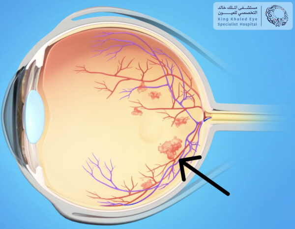 تكوُن أوعية دموية غير طبيعية في الشبكية ( السهم ) مما يستدعي العلاج بالليزر
