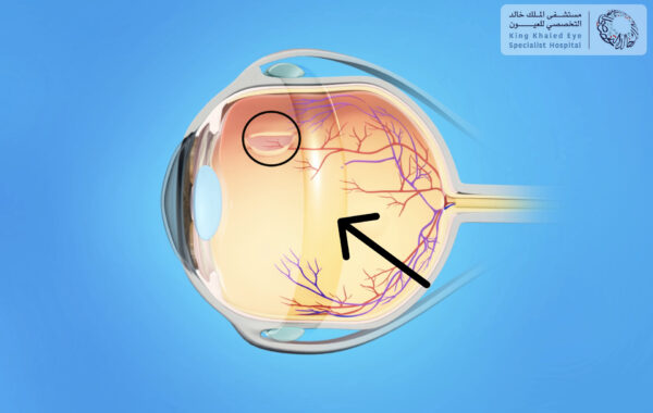 صورة توضيحية لحزام العين ( السهم ) والذي يستخدم لعلاج انفصال الشبكية ( الدائرة )