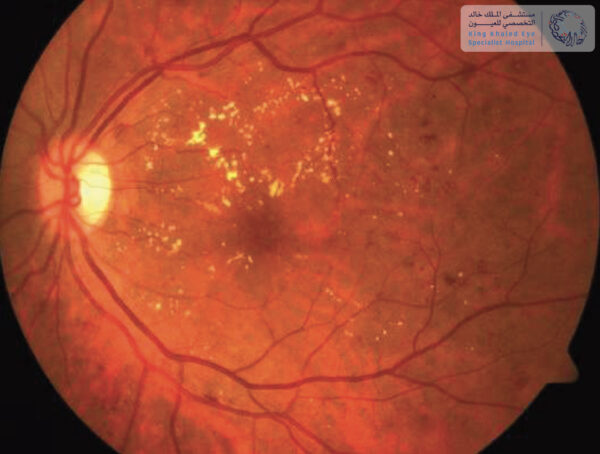 صورة لشبكية متأثرة بمرض السكري