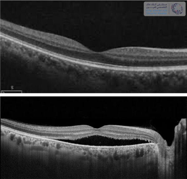 التصوير الطبقي لشبكية العين : شبكية طبيعية ( الصورة العلوية ) ، تصوير يظهر تجمع سوائل تحت مركز البصر ( الصورة السفلية )