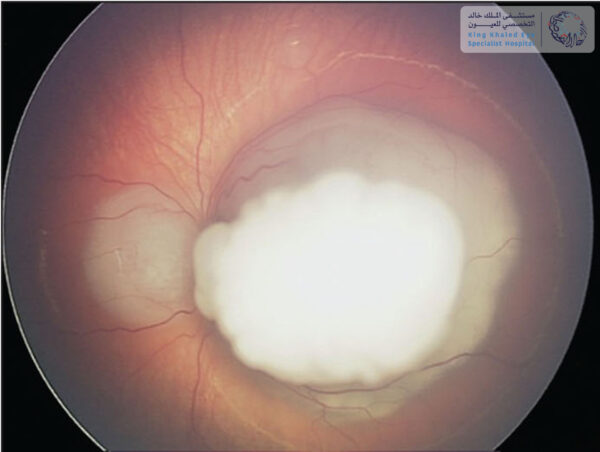 صورة لشبكية مريض مصاب بورم جذيعات شبكية