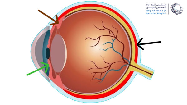 صورة توضيحية لأجزاء عنبية العين : المشيمية (السهم الأسود) ، الجسم الهدبي (السهم البني) ، القزحية (السهم الأخضر)