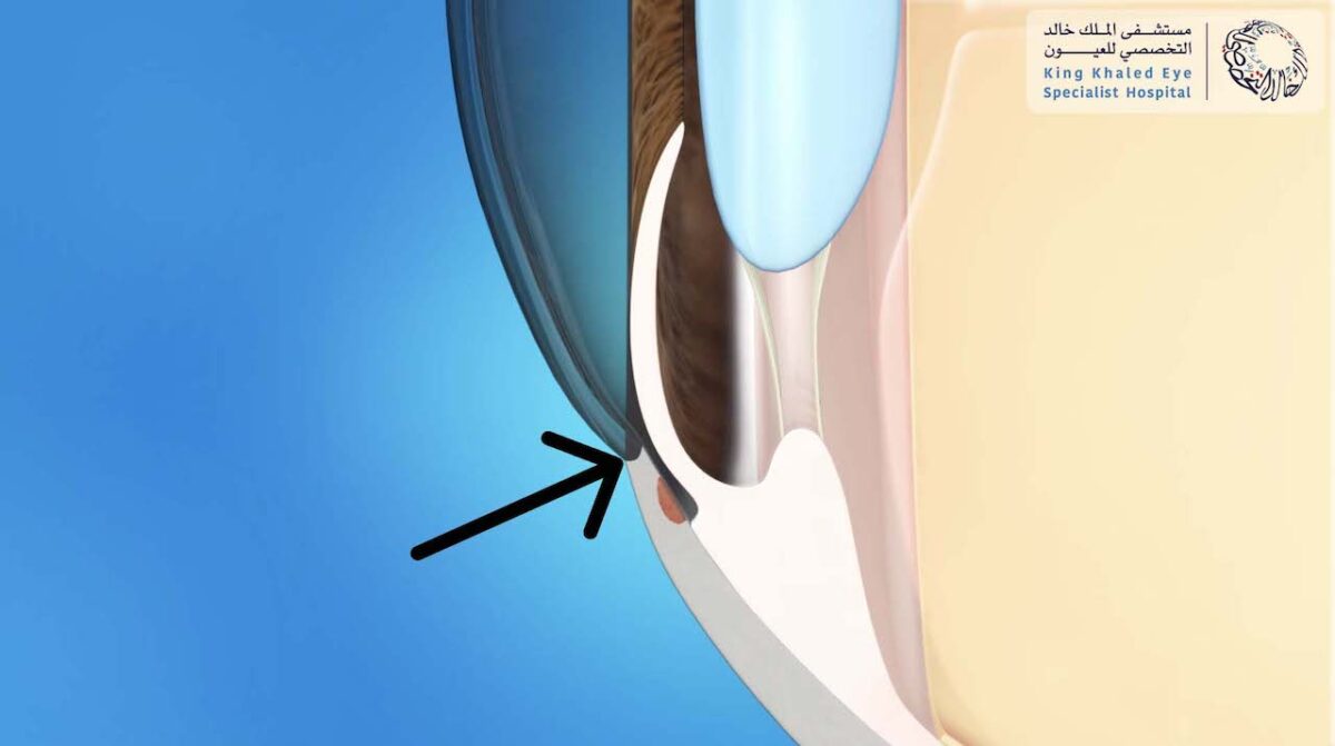 laser-peripheral-iridotomy