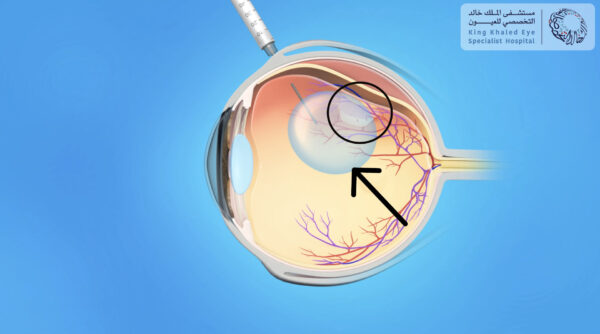 صورة توضيحية لحقن الهواء داخل العين ( السهم ) و ذلك لرقع انفصال في الشبكية ( الدائرة )