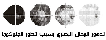 صورة توضح تدهور المجال البصري بسبب الجلوكوما