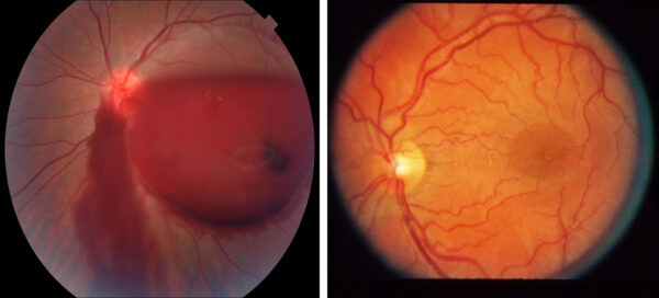 صورة لشبكية طبيعية ( اليمين ) و صورة لشبكية بها نزيف ( اليسار )