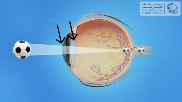 عدم انتظام شكل القرنية أو العدسة (الأسهم) يمنع أشعة الضوء من التركيز بشكل واضح على الشبكية