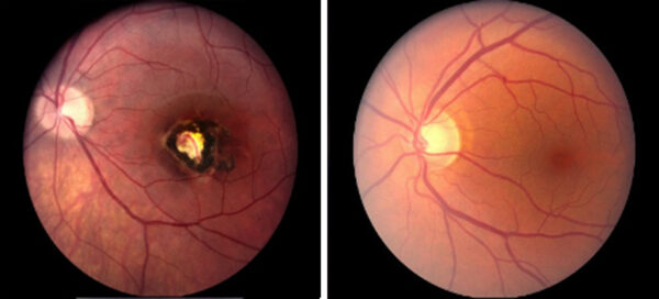 صورة لشبكية طبيعية ( اليمين ) و صورة لشبكية مصاب بداء المقوسات الخلقي يظهر بها ندبة في مركز الإبصار ( اليسار )