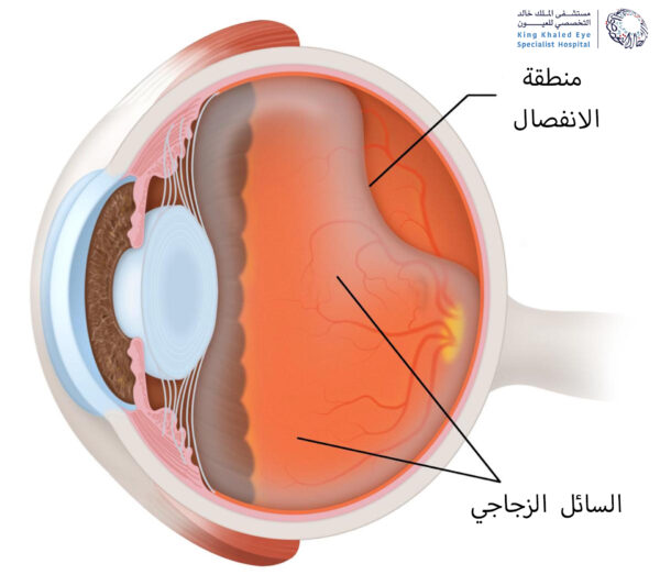 صورة توضيحية لانفصال السائل الزجاجي