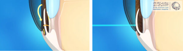 إجراء الليزر لتوسعة زاوية العين (اليمين) و من ثم تحسن مجرى السائل إلى خارج العين (اليسار)