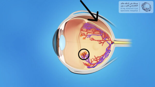 أوعية دموية غير طبيعية في الشبكية ( الدائرة ) قد تؤدي إلى انفصال في الشبكية ( السهم )