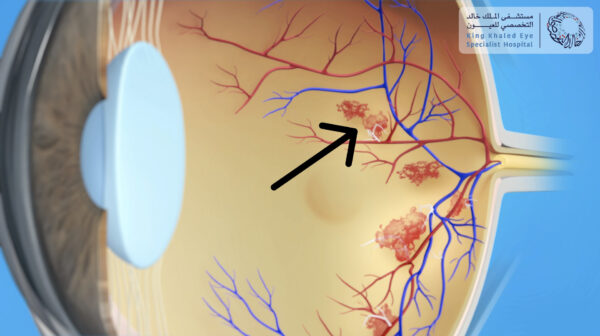 نمو أوعية دموية غير طبيعية على سطح الشبكية ( السهم ) في حالات اعتلال الشبكية التكاثري
