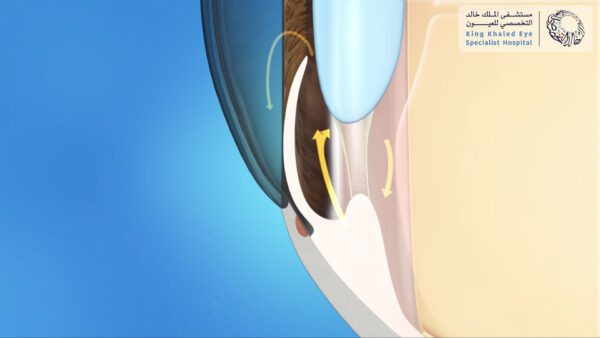 ضيق زاوية العين يؤدي إلى ضعف في تصريف السائل إلى خارج العين